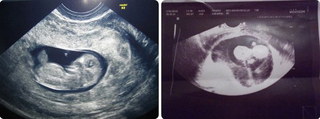 10th Weeks Pregnant Ultrasound